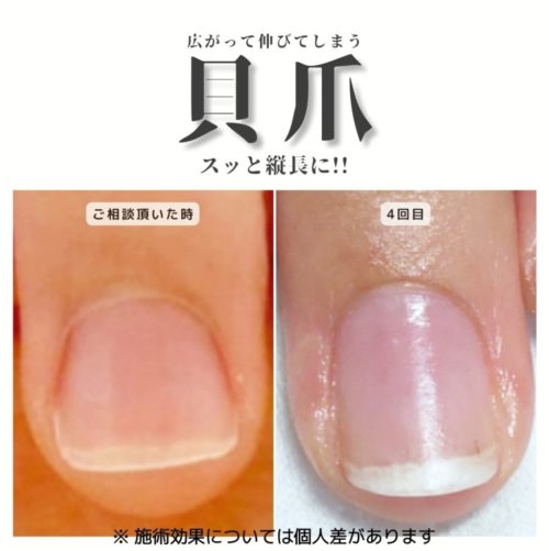 04-3　回爪　育成前・結果